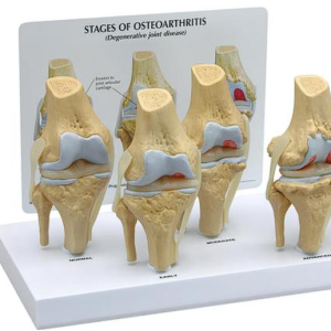 Conjunto de Modelos de Joelho Osteo de 4 Estágios
